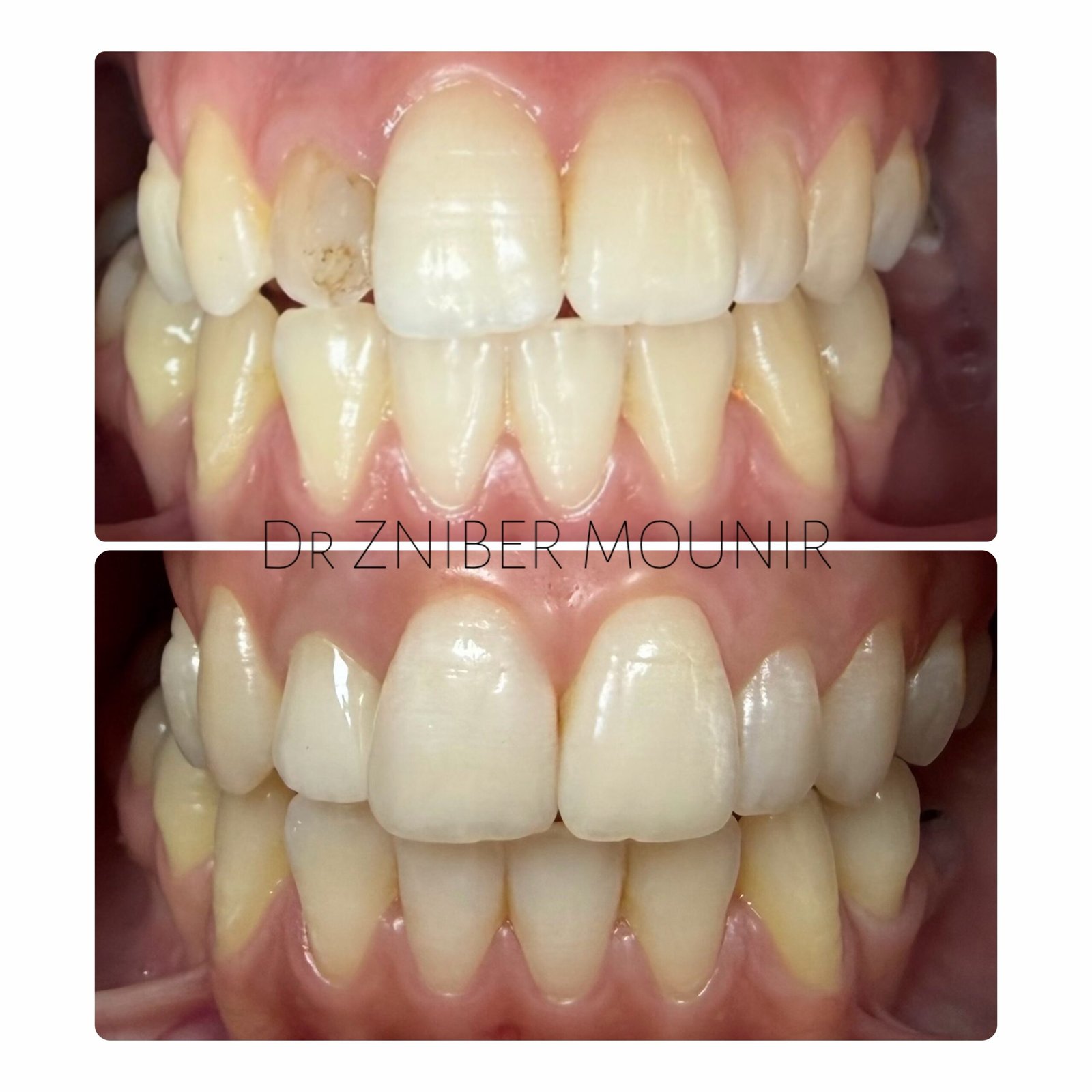 Cas clinique couronne zircone – Clinique Casa Anoual
