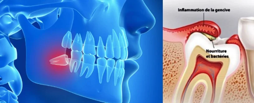 Dent de sagesse semi-incluse avec inflammation de la gencive (péricoronarite)