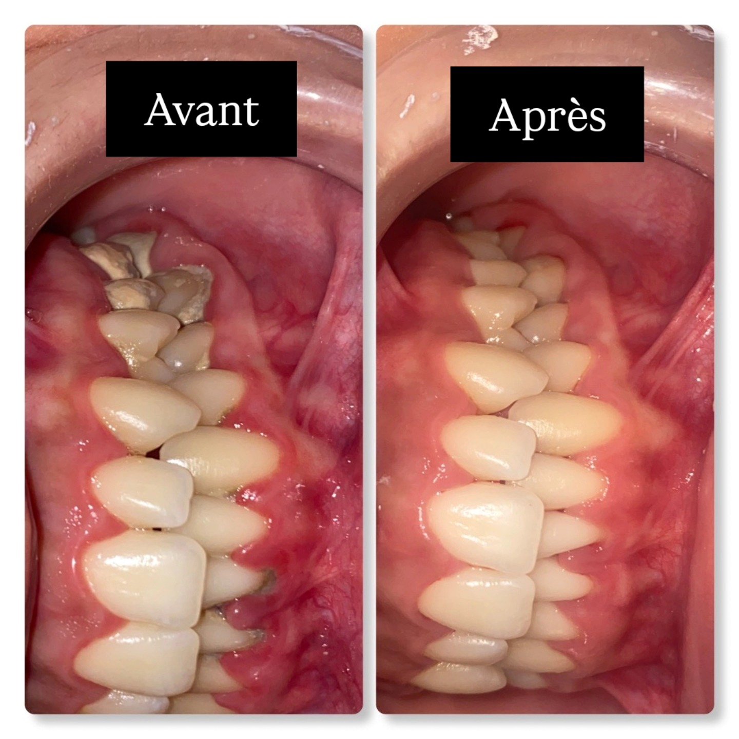 Cas clinique détartrage – Clinique Casa Anoual