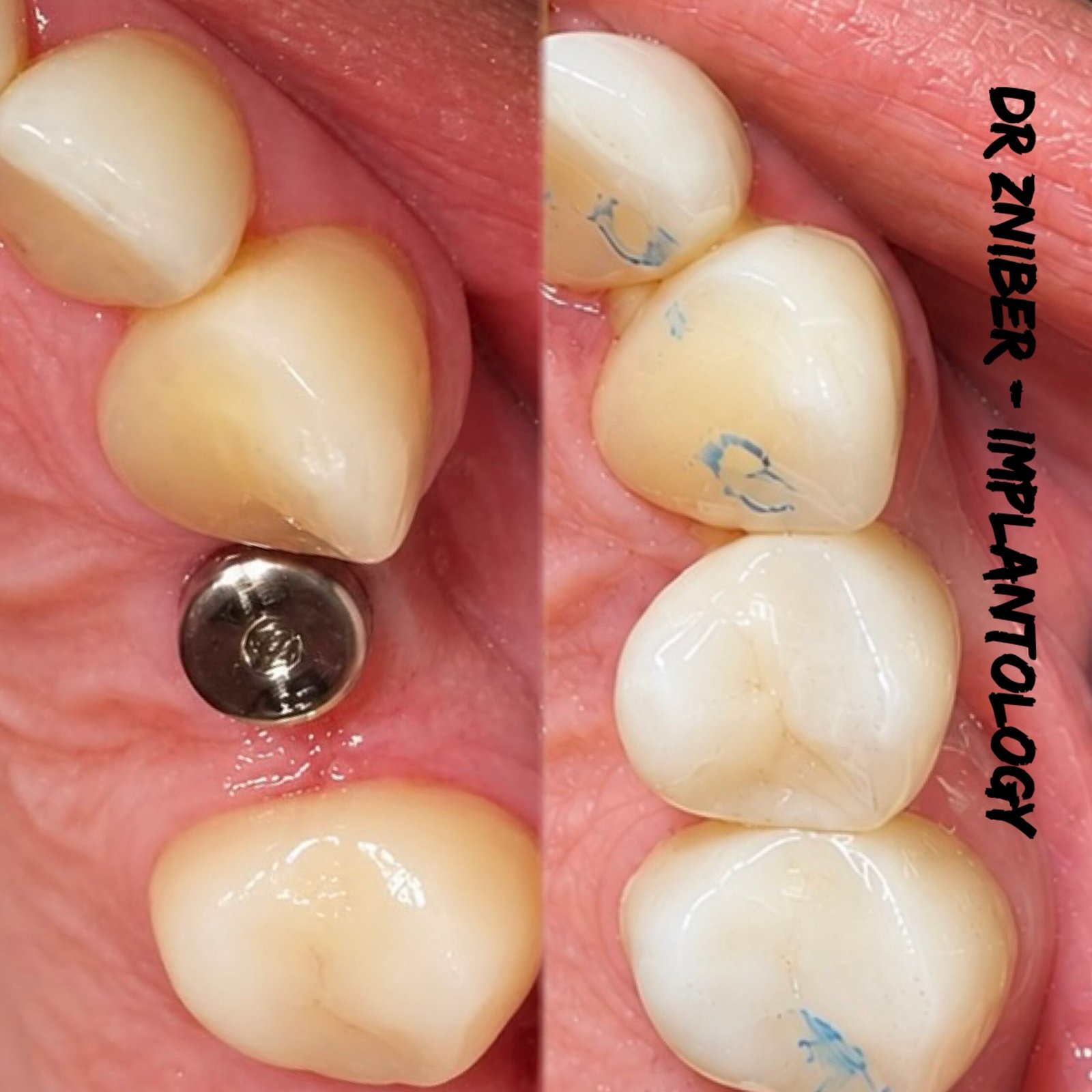 Cas clinique implant unitaire guidé – Clinique Casa Anoual