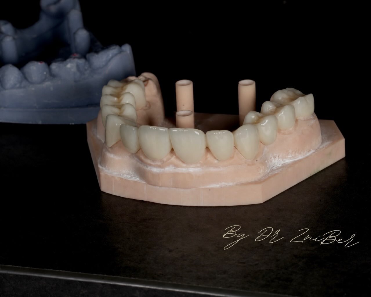 Prothèse sur implants