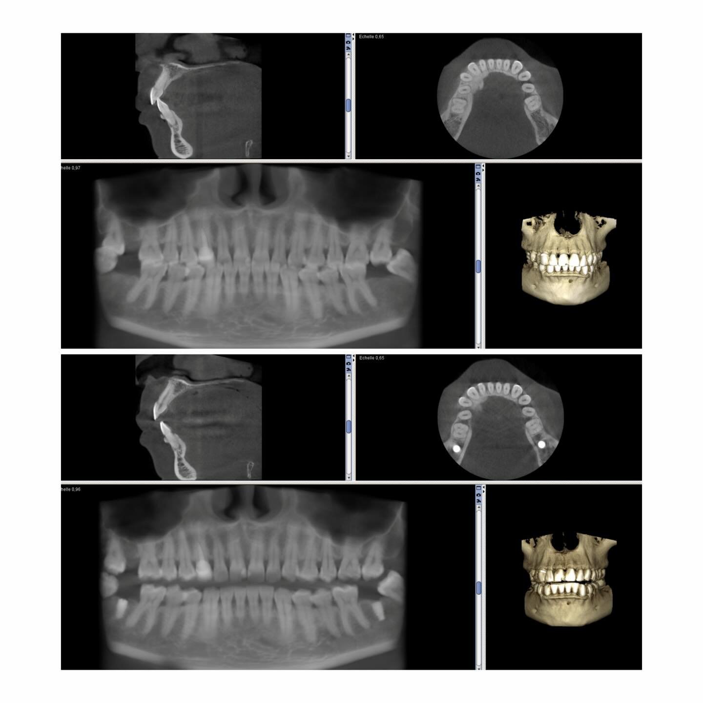 Planification implantaire sur CBCT