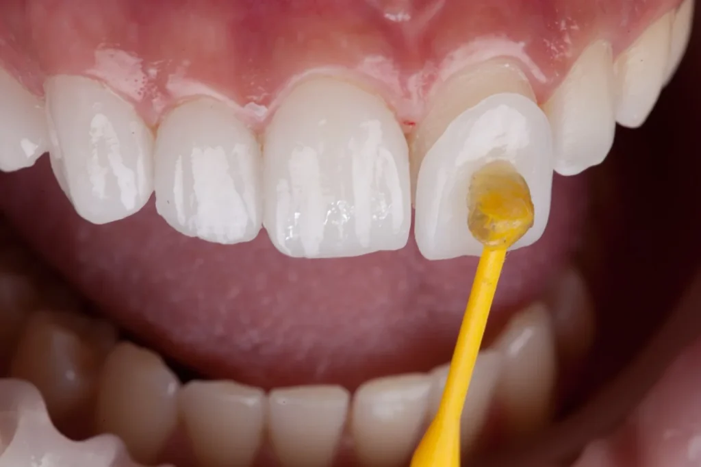 Pose d'une facette dentaire en céramique sur une incisive