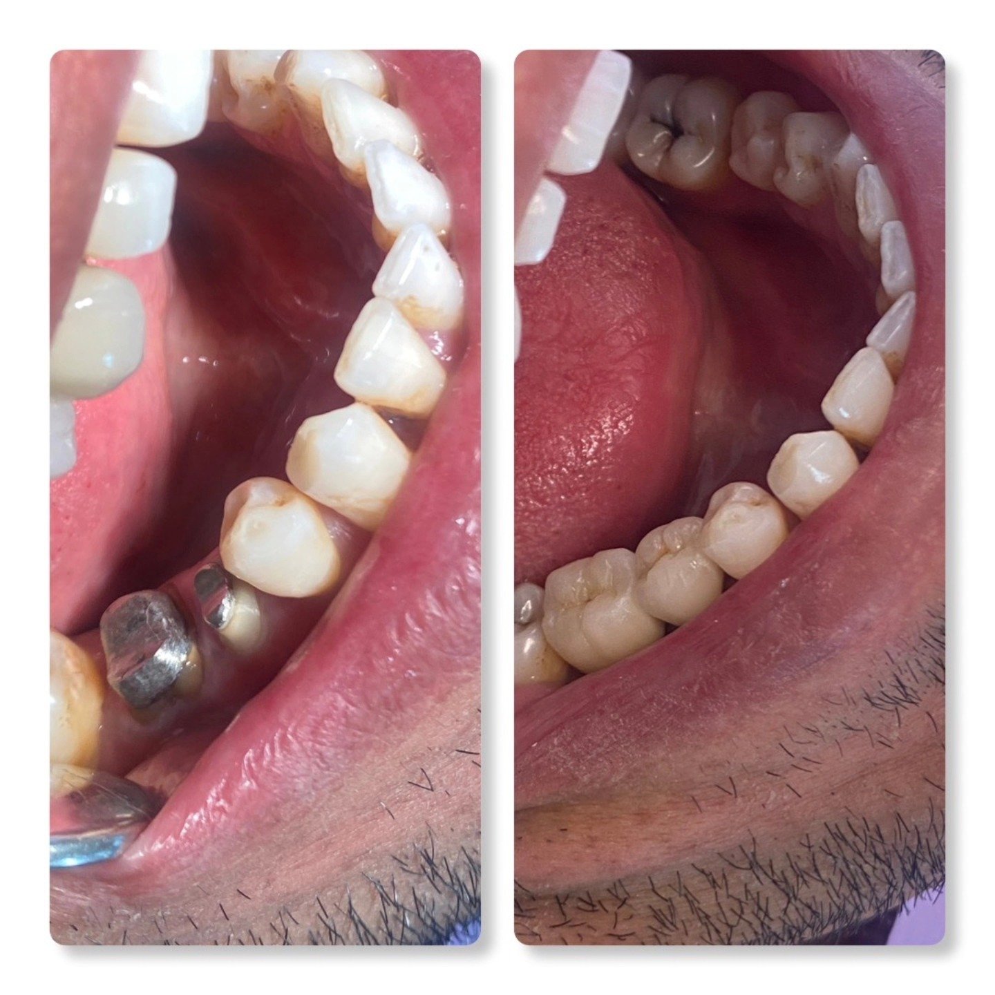 Cas clinique réhabilitation céramique – Clinique Casa Anoual