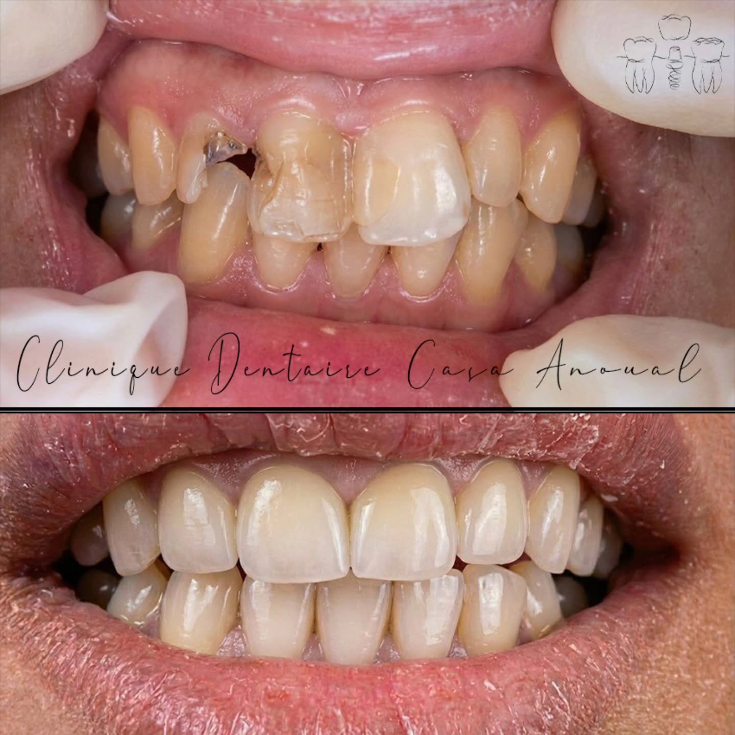 Cas clinique usure et fractures corrigées – Clinique Casa Anoual